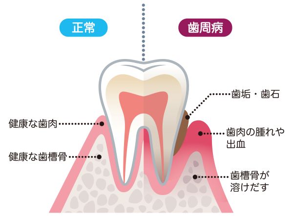 歯周病が身体の病気を引き起こす